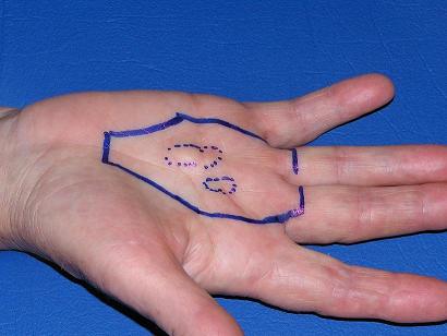 Dupuytren's disease in early stage, prior to radiotherapy. No contracture yet.