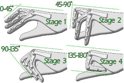 Angle measurement and stages of Dupuytren's contracture