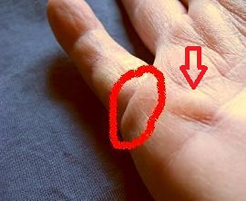 Am Grundgelenk des kleinen Fingers entwickelt sich ein Dupuytren-Knoten, unterhalb wächst ein Strang.