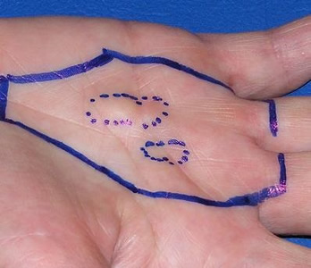 Kleine Dupuytren-Knoten in der Handinnenfläche. Hier kein Krebs!