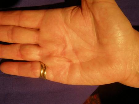 Palm six months after NA. Skin folds and Dupuytren cords flattened, finger is straight.