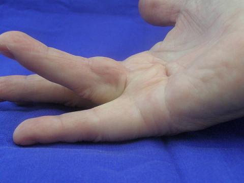 Finger with Dupuytren's contracture before needle aponeurotomy (NA or needle fasciotomy)