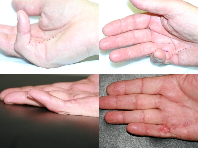 Treatment of Dupuytren's contracture in stage 4 with needle aponeurotomy (NA, PNF).
