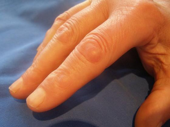 Knuckle pads, also called Garrod's pads, often come with Dupuytren's contracture