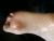 Fibroma on ball of foot.jpg