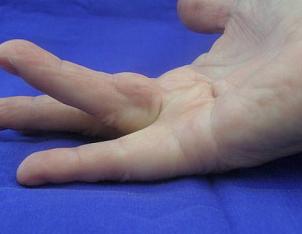 Dupuytren's contracture (Dupuytrens) with 35 deg, stage 1