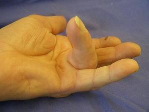 Dupuytren's contracture (Dupuytrens) with 100 deg, stage 3