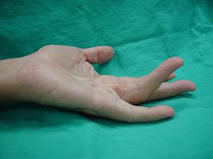 Dupuytren's contracture, stage 2, angle bigger than 45 degree