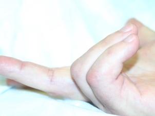 Dupuytren's contracture (Dupuytrens) with about 150 deg, early stage 4