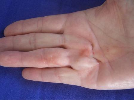 Palm showing folded skin due to Dupuytren's contracture and needle insertion points.