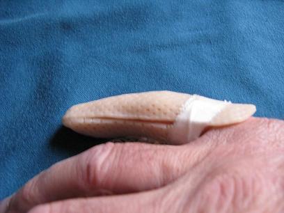 Night splint applied to little finger