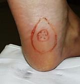 Small Ledderhose nodule on the sole of the foot.