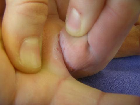 Dupuytren's contracture in progressed stage with already damaged skin, prior to needle aponeurotomy (NA).